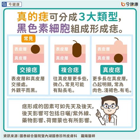 右下巴痣長毛|是痣or皮膚癌？醫「1張圖秒對照」 長這2部位最危險